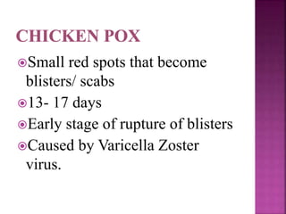 Small red spots that become
blisters/ scabs
13- 17 days
Early stage of rupture of blisters
Caused by Varicella Zoster
virus.
 