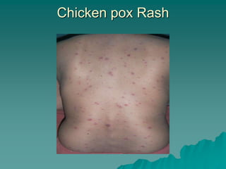 Chicken pox Rash
 