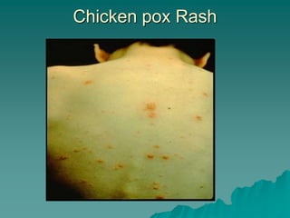 Chicken pox Rash
 