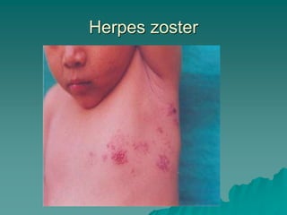 Herpes zoster
 