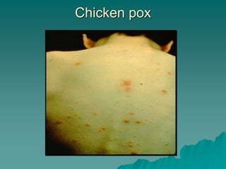 Chicken pox
 