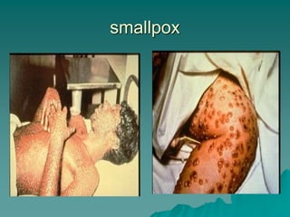 smallpox
 