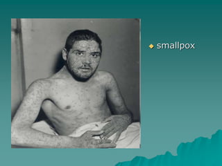  smallpox
 