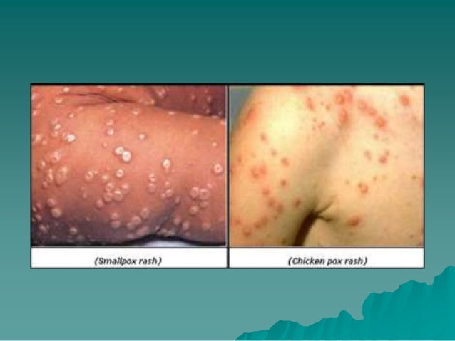 Communicable diseases smallpox & chiken pox