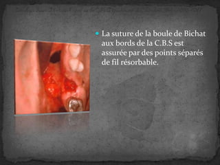  La suture de la boule de Bichat

aux bords de la C.B.S est
assurée par des points séparés
de fil résorbable.

 