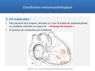 2. CIV trabéculées :
• Elles peuvent être uniques, devisées en 2 par la trabécule septomarginale,
ou multiples réalisant un aspect en « fromage de Gruyère ».
• le faisceau de conduction est à distance.
Classification anatomopathologique
 