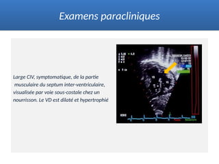 Large CIV, symptomatique, de la partie
musculaire du septum inter-ventriculaire,
visualisée par voie sous-costale chez un
nourrisson. Le VD est dilaté et hypertrophié
Examens paracliniques
 