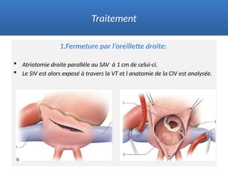 1.Fermeture par l’oreillette droite:
 Atriotomie droite parallèle au SAV à 1 cm de celui-ci.
 Le SIV est alors exposé à travers la VT et l anatomie de la CIV est analysée.
Traitement
 