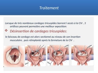 Lorsque de très nombreux cordages tricuspides barrent l accès à la CIV , 3
artifices peuvent permettre une meilleur exposition:
 Désinsertion de cardages tricuspides:
le faisceau de cordage est alors sectionné au niveau de son insertion
musculaire , puis réimplanté après la fermeture de la CIV .
Traitement
 