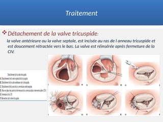 Détachement de la valve tricuspide:
la valve antérieure ou la valve septale, est incisée au ras de l anneau tricuspide et
est doucement rétractée vers le bas. La valve est réinsérée après fermeture de la
CIV.
Traitement
 