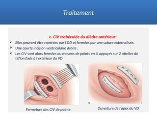 .
c. CIV trabéculée du dièdre antérieur:
 Elles peuvent être repérées par l’OD et fermées par une suture externalisée.
 Une courte incision ventriculaire droite .
 Les CIV sont alors fermées au moyens de points en U appuyés sur 2 attelles de
téflon fixés à l’extérieur du VD
Traitement
Ouverture de l’apex du VD
Fermeture des CIV de pointe
 