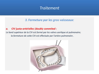 3. Fermeture par les gros vaisseaux:
a. CIV juxta-artérielles (doubly commited :
Le bord supérieur de la CIV est formé par les valves aortique et pulmonaire;
la fermeture de cette CIV est effectuée par l’artère pulmonaire .
Traitement
 