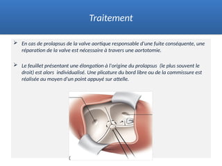  En cas de prolapsus de la valve aortique responsable d'une fuite conséquente, une
réparation de la valve est nécessaire à travers une aortotomie.
 Le feuillet présentant une élongation à l'origine du prolapsus (le plus souvent le
droit) est alors individualisé. Une plicature du bord libre ou de la commissure est
réalisée au moyen d'un point appuyé sur attelle.
Traitement
 