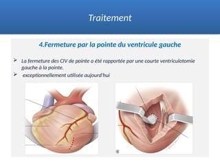 4.Fermeture par la pointe du ventricule gauche
 La fermeture des CIV de pointe a été rapportée par une courte ventriculotomie
gauche à la pointe.
 exceptionnellement utilisée aujourd'hui
Traitement
 