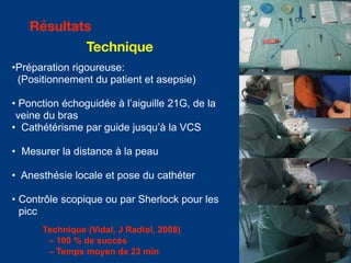 •Préparation rigoureuse:
(Positionnement du patient et asepsie)
• Ponction échoguidée à l’aiguille 21G, de la
veine du bras
• Cathétérisme par guide jusqu’à la VCS
• Mesurer la distance à la peau
• Anesthésie locale et pose du cathéter
• Contrôle scopique ou par Sherlock pour les
picc
Technique (Vidal, J Radiol, 2008)
– 100 % de succès
– Temps moyen de 23 min
Résultats
Technique
 