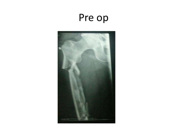 comminuted segmental fracture of femur shaft comminuted fracture