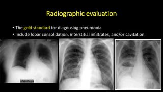 Radiographic evaluation
• The gold standard for diagnosing pneumonia
• Include lobar consolidation, interstitial infiltrates, and/or cavitation
 