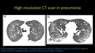 High-resolution CT scan in pneumonia
Viruses, Mycoplasma, and Chlamydia. In: Imaging of Pulmonary Infections, Müller NL, Franquet T, Lee KS (Eds), Lippincott
Williams & Wilkins, Philadelphia 2007. Copyright © 2007 Lippincott Williams & Wilkins
 