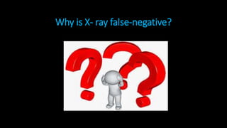 Why is X- ray false-negative?
 