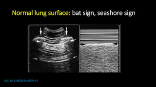 Normal lung surface: bat sign, seashore sign
DOI: 10.1186/2110-5820-4-1
 