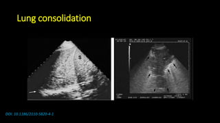 Lung consolidation
DOI: 10.1186/2110-5820-4-1
 