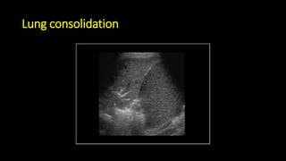 Lung consolidation
 