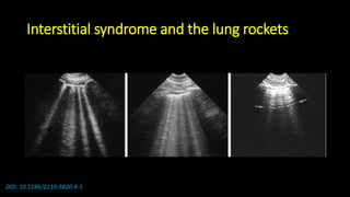 Interstitial syndrome and the lung rockets
DOI: 10.1186/2110-5820-4-1
 