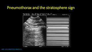 Pneumothorax and the stratosphere sign
DOI: 10.1186/2110-5820-4-1
 