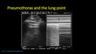 Pneumothorax and the lung point
DOI: 10.1186/2110-5820-4-1
 