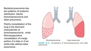 COMMUNITY ACQUIRED PNEUMONIA - Important Points.pdf