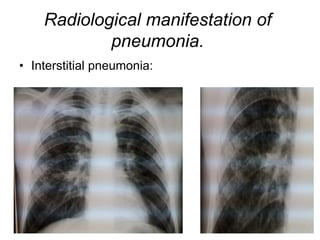 Radiological manifestation of
pneumonia.
• Interstitial pneumonia:
 