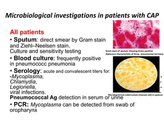 Microbiological investigations in patients with CAP
All patients
• Sputum: direct smear by Gram stain
and Ziehl–Neelsen stain.
Culture and sensitivity testing
• Blood culture: frequently positive
in pneumococc pneumonia
• Serology: acute and convalescent titers for:
-Mycoplasma, -
Chlamydia, -
Legionella, -
viral infections. -
Pneumococcal Ag detection in serum or urine
• PCR: Mycoplasma can be detected from swab of
oropharynx
Gram stain of sputum showing Gram-positive
diplococci characteristic of Strep. pneumoniae (arrows).
Mycobacterium tuberculosis (stained red) in sputum
 