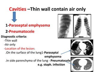 Cavities –Thin wall contain air only
Diagnostic criteria:
-Thin wall
-Air only
-Location of the lesion:
.On the surface of the lung1-Paraseptal
emphysema
.In side parenchyma of the lung - Pneumatocele
e.g. staph. infection
1-Paraseptal emphysema
2-Pneumatocele
 