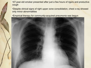 •47-year-old smoker presented after just a few hours of rigors and productive
cough
•Despite clinical signs of right upper zone consolidation, chest x-ray showed
only minor abnormalities
•Empirical therapy for community-acquired pneumonia was begun
 