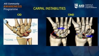 CARPAL INSTABILITIES
CID CIND
 