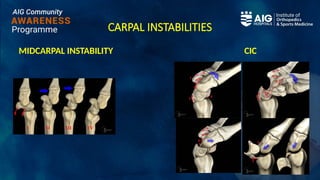 CARPAL INSTABILITIES
MIDCARPAL INSTABILITY CIC
 