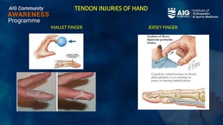 TENDON INJURIES OF HAND
MALLET FINGER JERSEY FINGER
 