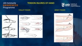 TENDON INJURIES OF HAND
MALLET FINGER JERSEY FINGER
 