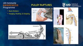 PULLEY RUPTURES
• Rock Climbers
• Hanging, Hooking & Gripping
 