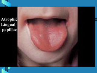 Atrophic
Lingual
papillae
 