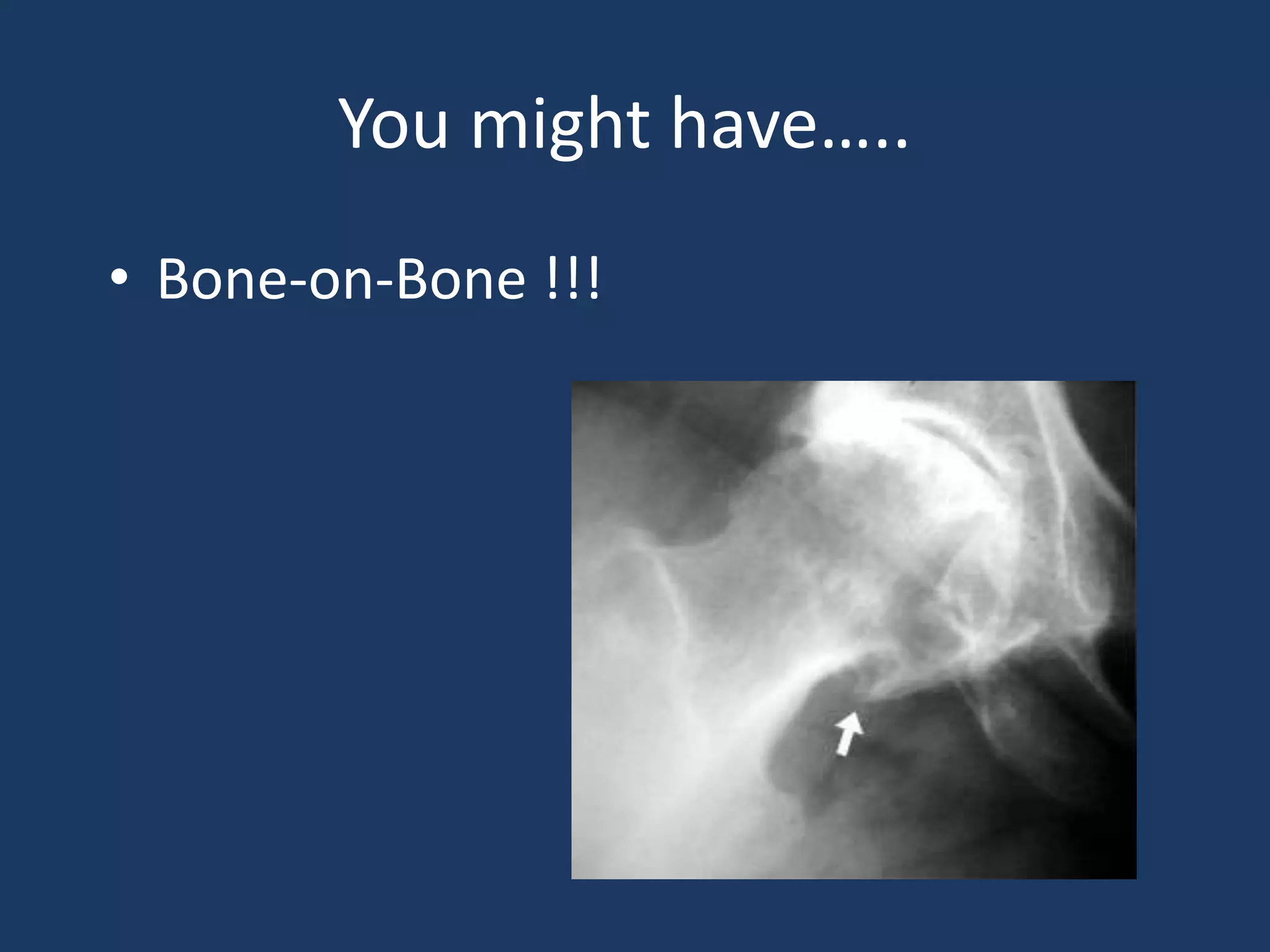 You might have…..
• Bone-on-Bone !!!
 