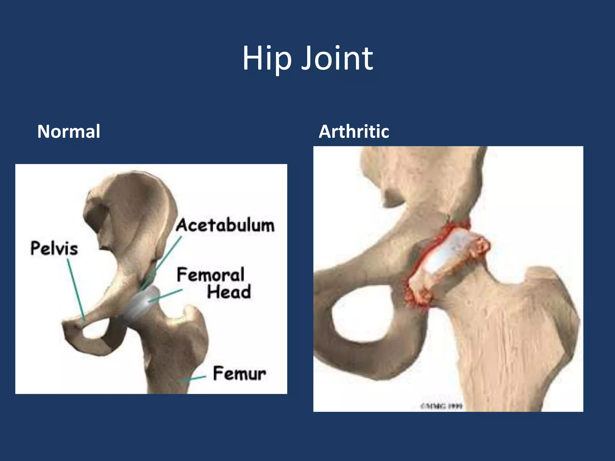 Hip Joint
Normal Arthritic
 