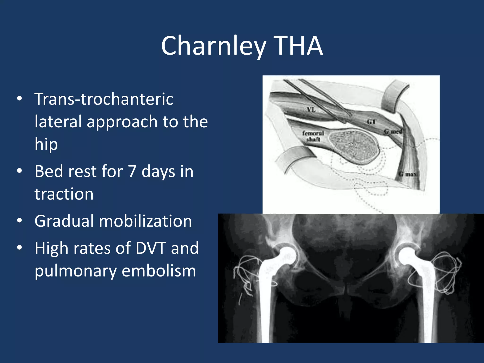 Charnley THA
• Trans-trochanteric
lateral approach to the
hip
• Bed rest for 7 days in
traction
• Gradual mobilization
• High rates of DVT and
pulmonary embolism
 