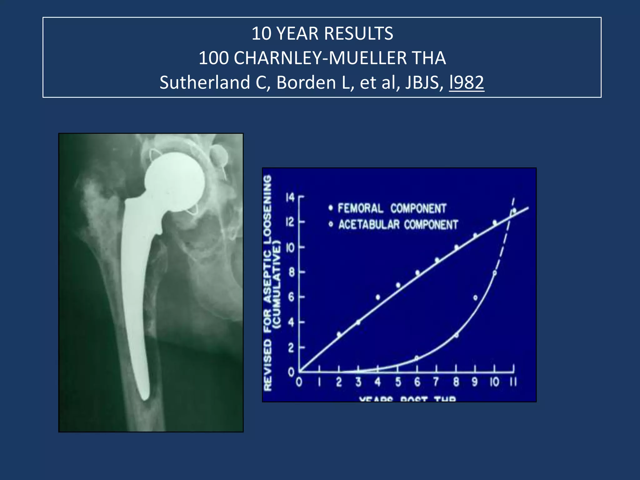 10 YEAR RESULTS
100 CHARNLEY-MUELLER THA
Sutherland C, Borden L, et al, JBJS, l982
 