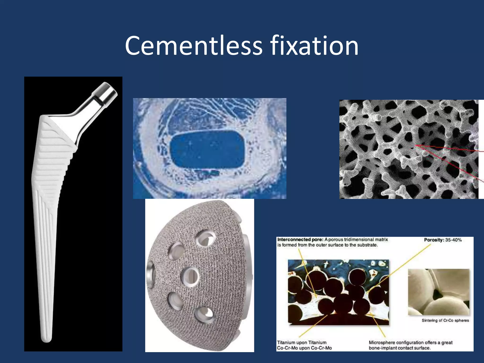 Cementless fixation
 