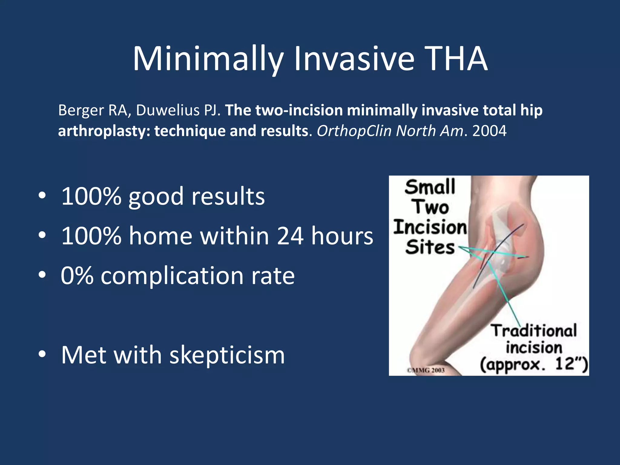 Minimally Invasive THA
• 100% good results
• 100% home within 24 hours
• 0% complication rate
• Met with skepticism
Berger RA, Duwelius PJ. The two-incision minimally invasive total hip
arthroplasty: technique and results. OrthopClin North Am. 2004
 