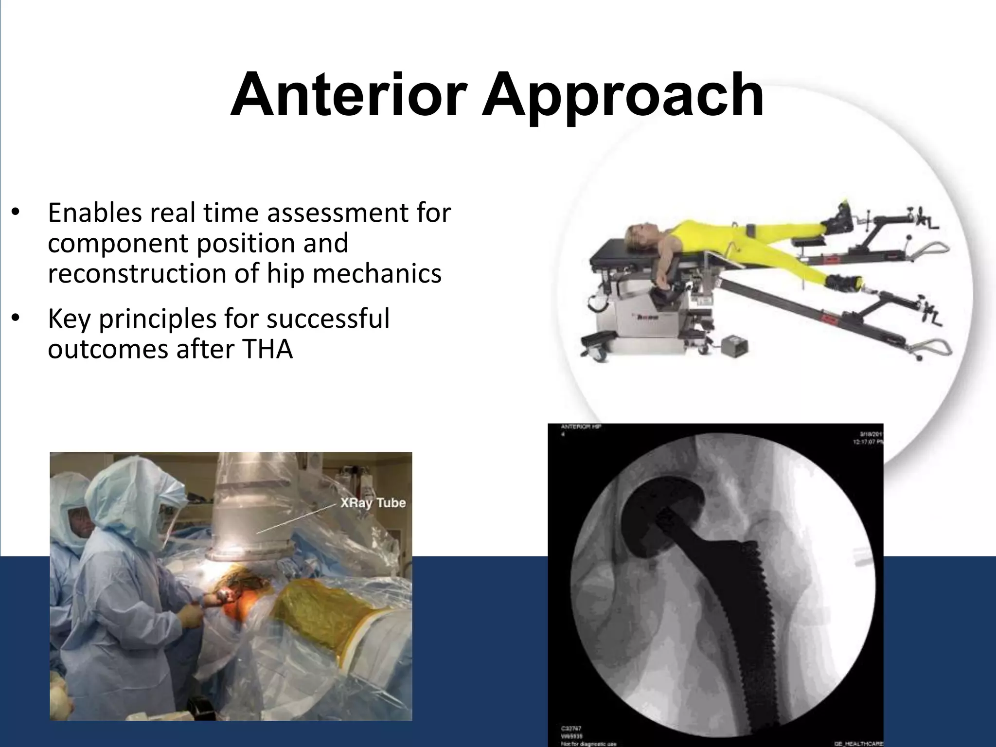 Anterior Approach
• Patients lie on back
• Enables real time assessment for
component position and
reconstruction of hip mechanics
• Key principles for successful
outcomes after THA
 