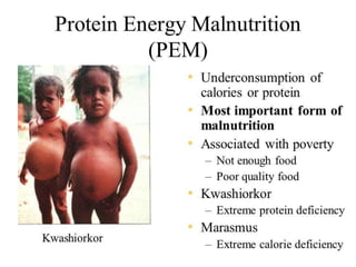 PROTEIN ENERGY MALNUTRITION
 