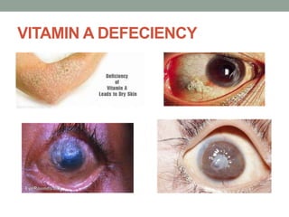 VITAMIN A DEFECIENCY
 