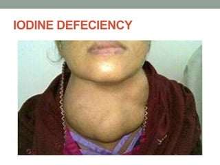 IODINE DEFECIENCY
 